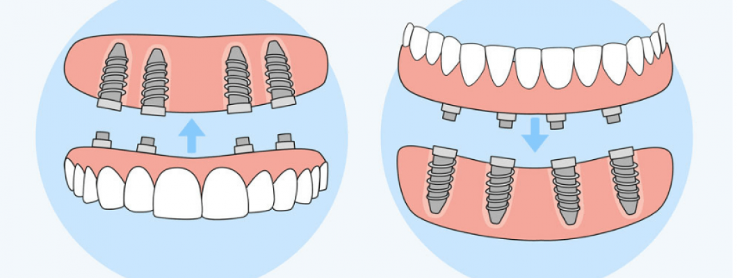 All On Four İmplant Nedir? Kimler İçin Uygundur?