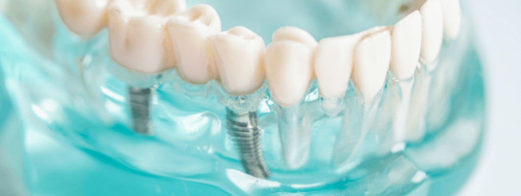 Implant Tedavisi Nedir?